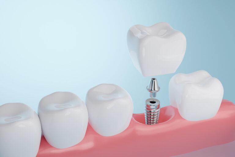 A 3D illustration showing the process of a dental implant. A dental crown is being placed onto an abutment connected to an implant screw embedded in the gum, between two natural teeth. The background is a soft gradient of light blue.
