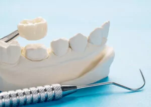 A close-up image of a dental model showing a section of teeth. One tooth crown is being held by dental tweezers above its corresponding place on the model. A dental tool with a hooked end is lying next to the model, all set against a light blue background.
